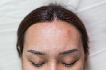 Asian beautiful woman is acne skin problem on forehead.