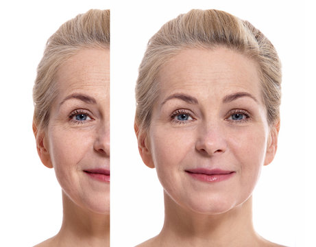 Middle aged woman face before and after cosmetic procedure. Plastic surgery concept.