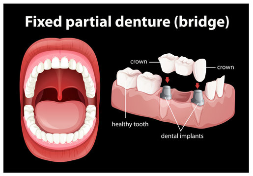 Medical Vector of Fixed Partial Denture