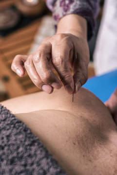 Therapist performing an acupuncture treatment on woman
