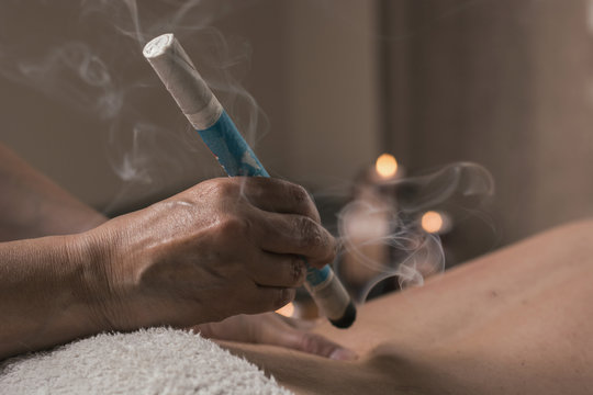 Therapist performing a moxibustion treatment.