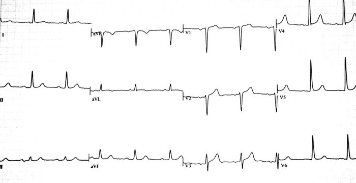 EKG Chart Printout Sheet On White Paper.