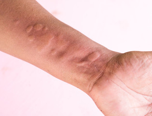 Skin Allergy Symptoms on hand