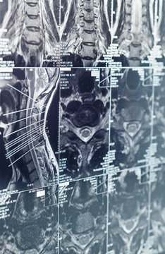 Sectional tomographic image of intervertebral disks of neck. Magnetic resonance tomography (MRT) of backbone