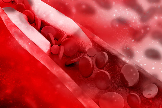 3d rendering blood cells with plaque buildup of cholesterol symbol of vascular illness