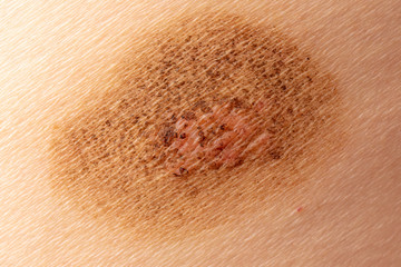 Ringworm on the human skin as a background
