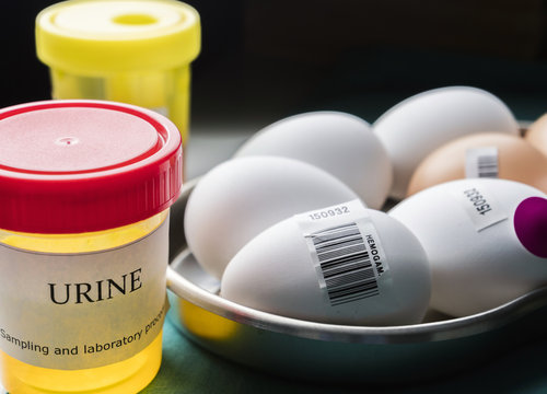 Urine samples and eggs in poor condition for examination in clinical laboratory, conceptual image