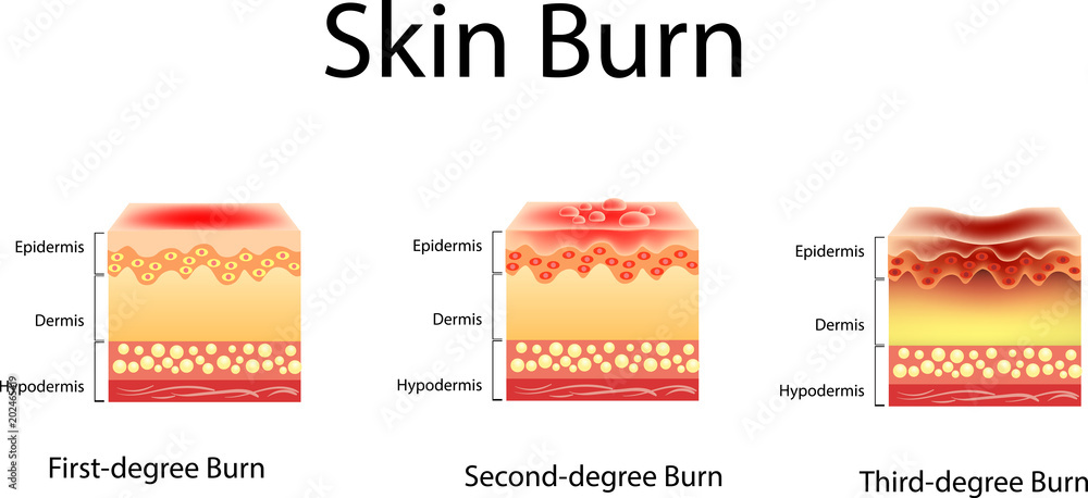 Wall mural skin burn. Three degrees of burns. type of injury to skin, Vector illustration