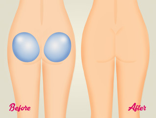 before and after buttocks remodeling - obrazy, fototapety, plakaty