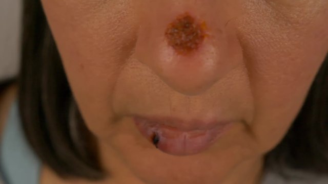 A mature woman after laser surgery for skin cancer