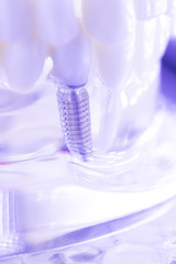 Dental titanium tooth implant