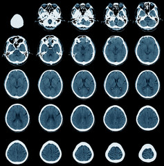 image of CT scan, x-ray computer of skull