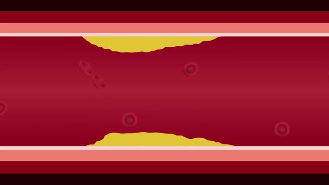 step of Atherosclerosis graphic animation . fat stuck in the blood artery cholesterol