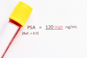 Abnormal high level PSA test result with blood sample