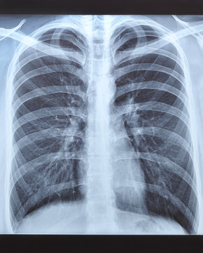 X-ray shot of a man's lungs.