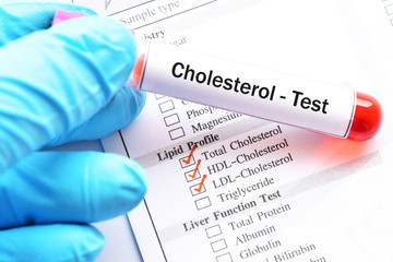 Test tube with blood sample for cholesterol test
