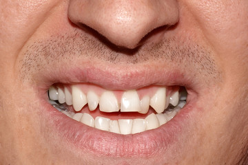 Close-up portrait of man with crooked white ugly teeth, terrible smile. Dental problem, care and...