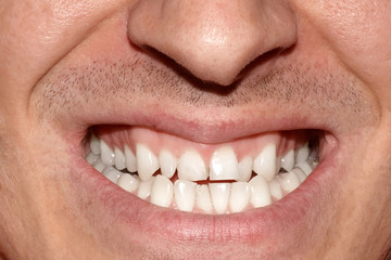 Close-up portrait of man with crooked white ugly teeth, terrible smile. Dental problem, care and...