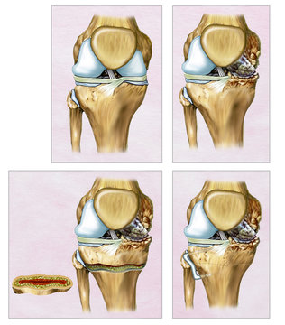 Ilustraci&oacute;n descriptiva una Osteotom&iacute;a o correcci&oacute;n de la rodilla en donde el f&eacute;mur y la tibia aparecen torcidas. La intervenci&oacute;n quir&uacute;rgica es realizada  por traumat&oacute;logos para re alinear la rodilla.