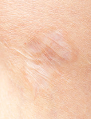 Fototapeta premium scar on the leg
