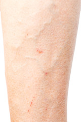 varicosity on the female leg