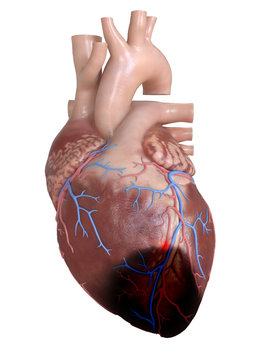 3d rendered, medically accurate illustration of a heart attack