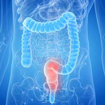 3d rendered, medically accurate illustration of an inflamed rectum
