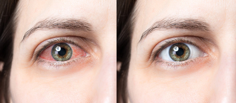 Irritated eye before and after using eye drops