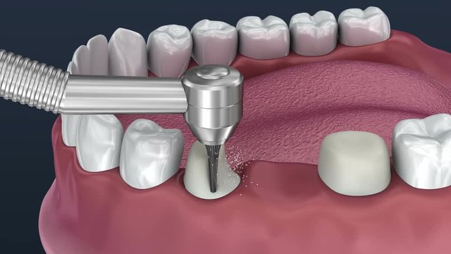 Tooth supported fixed bridge of 3 teeth. Medically accurate 3D Animation.