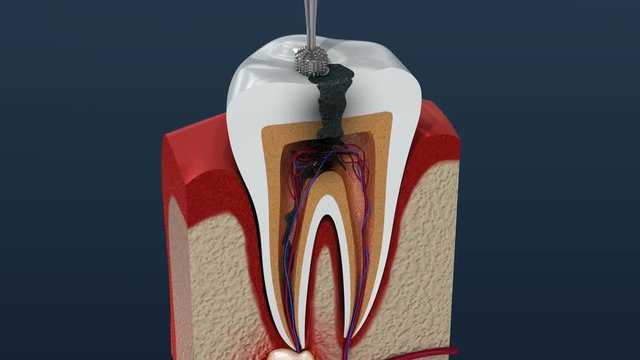 Root canal treatment process. 3D Animation.