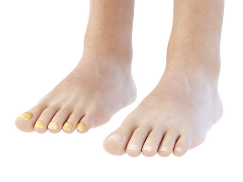 3d rendered, medically accurate illustration of toe nail fungus