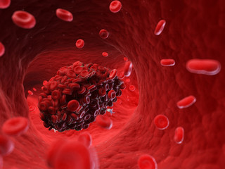 3d rendered, medically accurate illustration of a blood clot