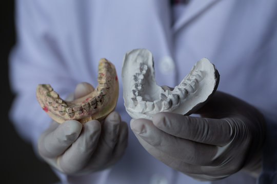 Study cast of Diagnostic cast and dental gypsum models in dental laboratory.