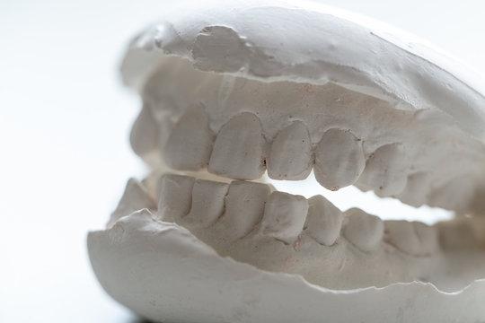 Study cast of Diagnostic cast and dental gypsum models in dental laboratory.