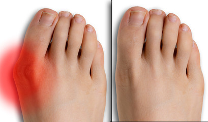 Pain caused by hallux valgus, comparison before and after surgery