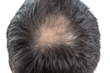 male head with circular thinning hair or alopecia - obrazy, fototapety, plakaty