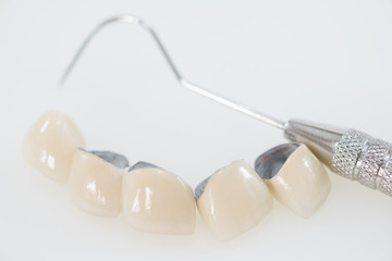 Fototapeta na wymiar Implan model tooth support fix bridge implan and crown.