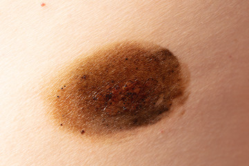 Fototapeta premium Ringworm on the human skin as a background