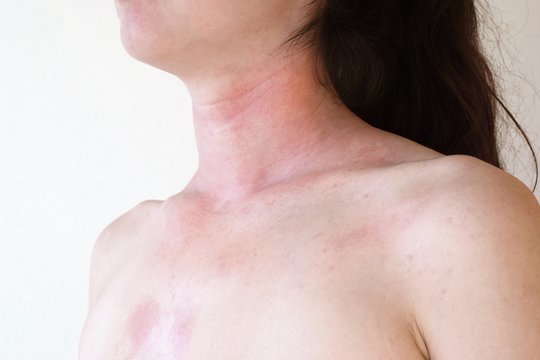 Allergic skin reaction on the female neck and face