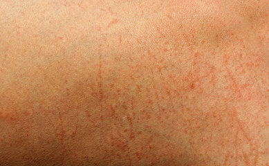 damaged skin texture from injury or sunburn