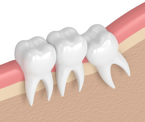 3d render of teeth with wisdom mesial impaction