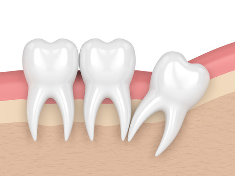 3d render of teeth with wisdom distal impaction