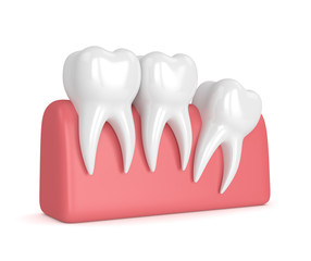 3d render of teeth with wisdom distal impaction