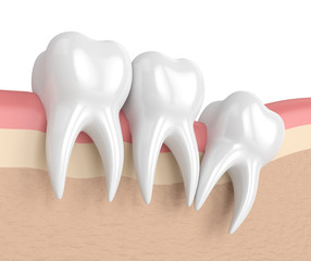 3d render of teeth with wisdom distal impaction