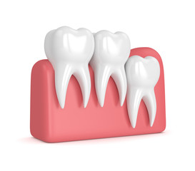 3d render of teeth with wisdom vertical impaction