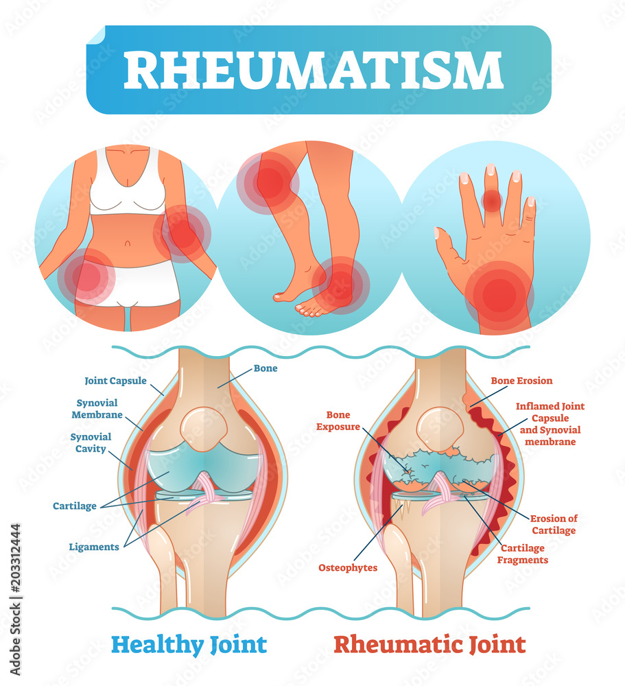 Canvas Prints Rheumatism medical health care vector illustration poster diagram with damaged knee erosion and painful body joints.