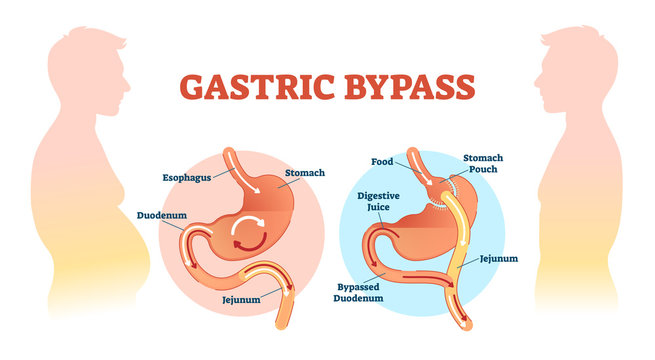 Gastric bypass medical surgery procedure vector illustration with esophagus, stomach, duodenum and jejunum flow.