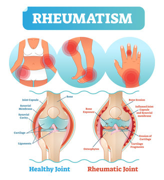 Rheumatism medical health care vector illustration poster diagram with damaged knee erosion and painful body joints.