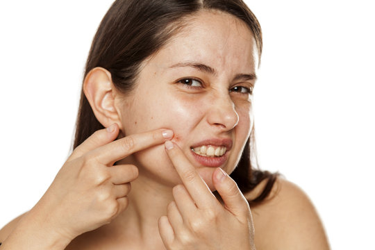 Young woman sqeezing a pimple on her cheek on white background