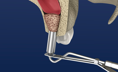 Sinus Lift Surgery - Sinus Augmentation. 3D illustration